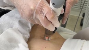 Лазерная шлифовка и коррекция шрамов, рубцов, растяжек, постакне FOTONA