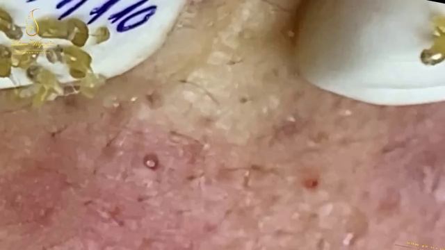 Loan Nguyen Acne Treatment 1435mh
