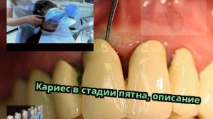 Кариес в стадии пятна, описание