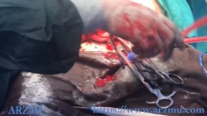 C-section (Cesarean Section) | Caesarean Delivery | All steps in a Cesarean Delivery