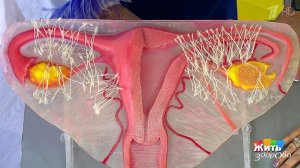 Спайки у женщин. Диагностика и лечение. Жить здорово! Фрагмент выпуска от 24.01.2019