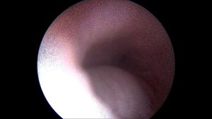 Парауретральная киста