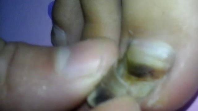 Отрывание ногтя. Жесть. Больно. смотреть онлайн