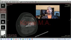 Перелом мыщелка большеберцовой кости. Ролик №8.