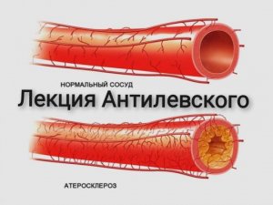 Атеросклероз. Антилевский.mp4
