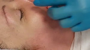 АирисКом студенты учатся: нити Cog для лифтинга носогубной складки 20 мин. 15 000р.