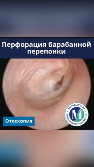 Отоскопия. Перфорация барабанной перепонки