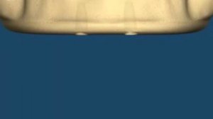 ЧТО ТАКОЕ ИМПЛАНТ ЗУБА И КАК ОН УСТАНАВЛИВАЕТСЯ