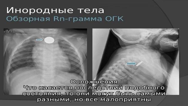 Чем опасен пломбировочный материал в гайморовой пазухе?