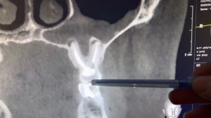 Одонтогенный гайморит на компьютерной томографии. Удаление "кисты" зуба. Периодонтит. Гранулема зуб