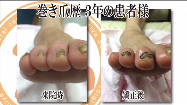 鷺沼・宮前平で巻き爪矯正【巻き爪治療センター】