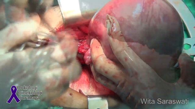 Total Abdominal Hysterectomy - Bilateral Salphingectomy смотреть онлайн