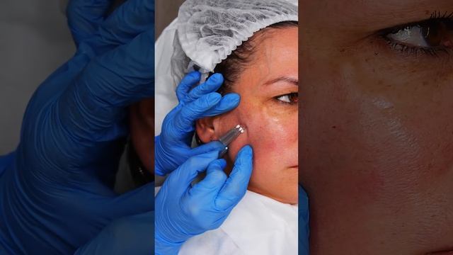 Коррекция малярных мешков с помощью нитей МОНО смотреть онлайн