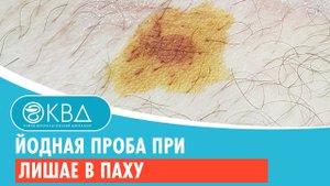 ✅ Йодная проба при лишае в паху. Клинический случай №268