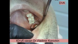 4 stage polishing of 25 27 teeth.  Ceramic bur+rubber cone bur+ polishing disk+ grid.