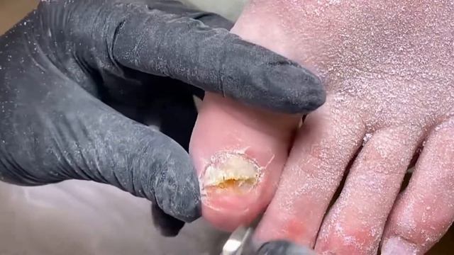 ОНИХОЛИЗИС 😨😳😱 • ЗАЧИСТКА ⚠️❗️🆘🦶🏻