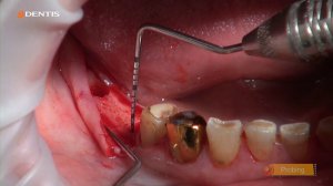 Др. Шумовский Д.Б. Имплантация  в области 46 и 47 зубов, менеджмент мягких тканей.