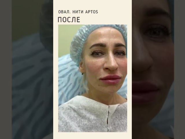 Полимолочные нити АПТОС Экселанс Визаж, 19 см #skincare #beauty #аптос #лифтинглица