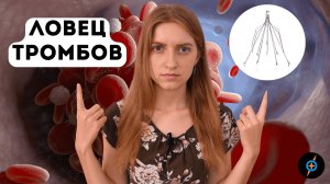 Как КАВА-ФИЛЬТР спасает жизнь больного, если оторвался тромб? | Mednavigator.ru