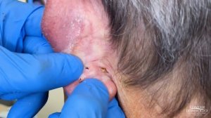 Years-old Blackhead Behind The Ear Extracted | CONTOUR DERMATOLOGY