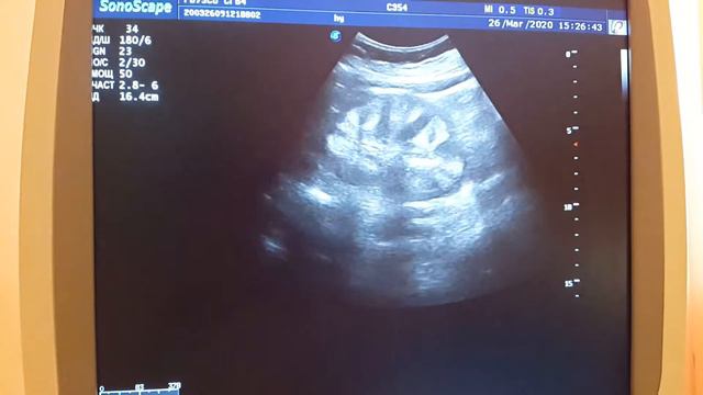 Гиперэхогенные пирамиды(2) смотреть онлайн