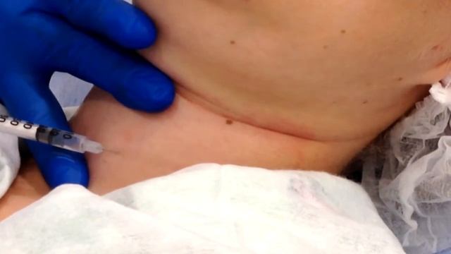 ЛИФТИНГ кожи, ШЕЯ: горизонтальные и вертикальные линии с применением БОТОКСА. смотреть онлайн