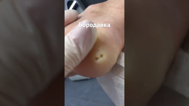Удаление бородавки смотреть онлайн