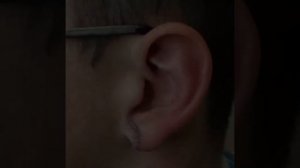 Пластика мочек ушей после туннелей