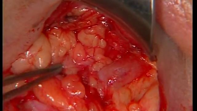 Эстетическая блефаропластика By Dr Darina Krastinova