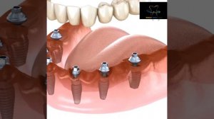 #dental #implantesdentarios #treatment #pain #bridges #advice #braces