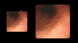 №7 Выявление рака желудка на ранних стадиях молочной железы