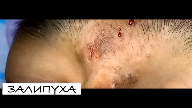 ВЫДАВЛИВАНИЕ ПРЫЩЕЙ. ВЫДАВЛИВАНИЕ ЧЕРНЫХ ТОЧЕК. УДАЛЕНИЕ И ВЫДАВЛИВАНИЕ ЧЕРНЫХ ТОЧЕК.УДАЛЕНИЕ ПРЫЩЕ смотреть онлайн