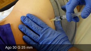 Укол (инъекция) коллагена в бедро (Guna)