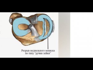 Ручка лейки.26 день после травмы колена,больничный закрыт,предложено сделать МРТ.