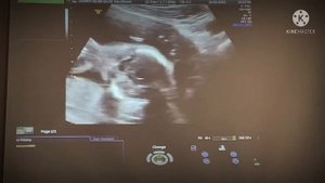 УЗИ плода  второй скрининг 16-20 недель .  В 3D режиме смотрим на сердца, глаза , кости и …