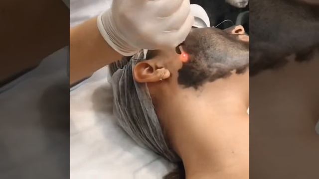 Лазерный карбоновый пилинг лица смотреть онлайн