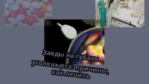 Заеды на губахв уголках рта: причины, как лечить