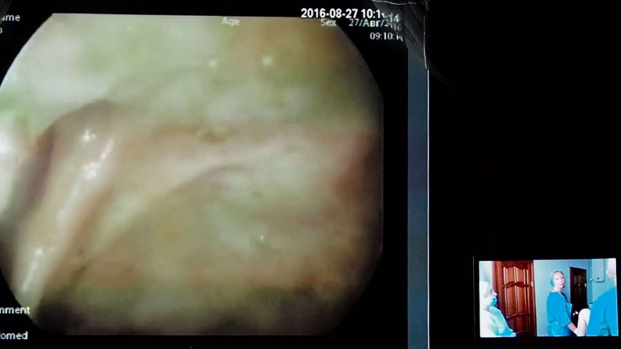 38 Live02 Полторыхина ЕА Колоноскопия при НЯК Подготовка Лавакол смотреть онлайн