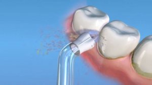 Чистка зубных имплантов при помощи ирригатора Waterpik