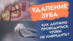 Удаление зуба. Операция. Как проходит, чтобы не навредить?