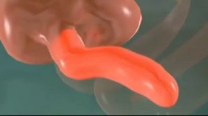 Аппендицит