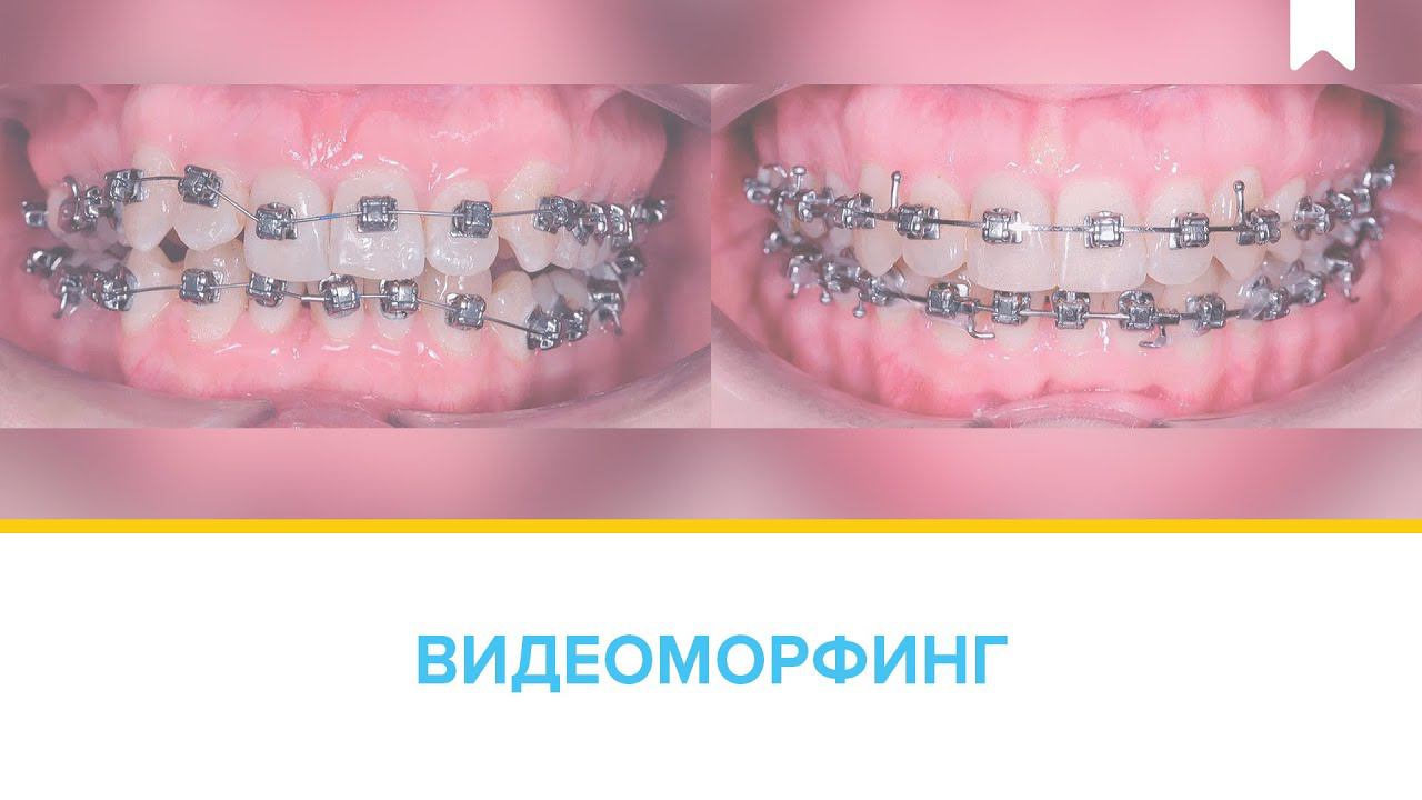 Результаты лечения скученности зубов БЕЗ удаления цифровой брекет-системой INSIGNIA