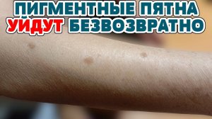 КАК УБРАТЬ ПИГМЕНТНЫЕ ПЯТНА, ШРАМЫ от АКНЕ, ВЕСНУШКИ на лице! Мазь от ПИГМЕНТАЦИИ, рецепт!