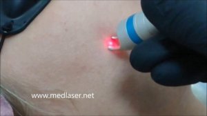 Удаление купероза (сосудов) диодным лазером. Новинка 2018! Аппарат L-001