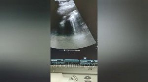 УЗИ плевральной полости, гемоторакс.