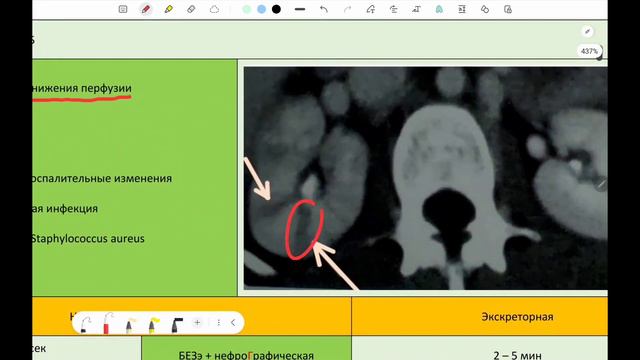 Острый пиелонефрит смотреть онлайн