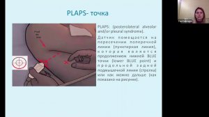 УЗД при тромбоэмболии легочной артерии Кренева Е Л