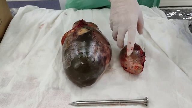 Киста яичника. Определение, виды.