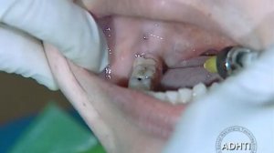 анестезия для блокады язычного нерва.....anesthesia for lingual nerve blockade