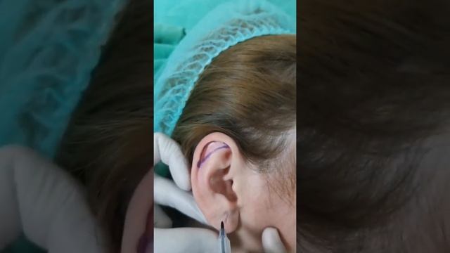 Отопластика в Баку